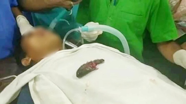 মাছ শিকারে গিয়ে গলায় ঢুকল কই!
