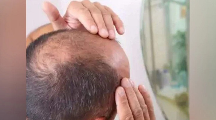 বিয়ের একমাস পর স্বামীর মাথায় টাক আছে জেনে যা করলেন স্ত্রী