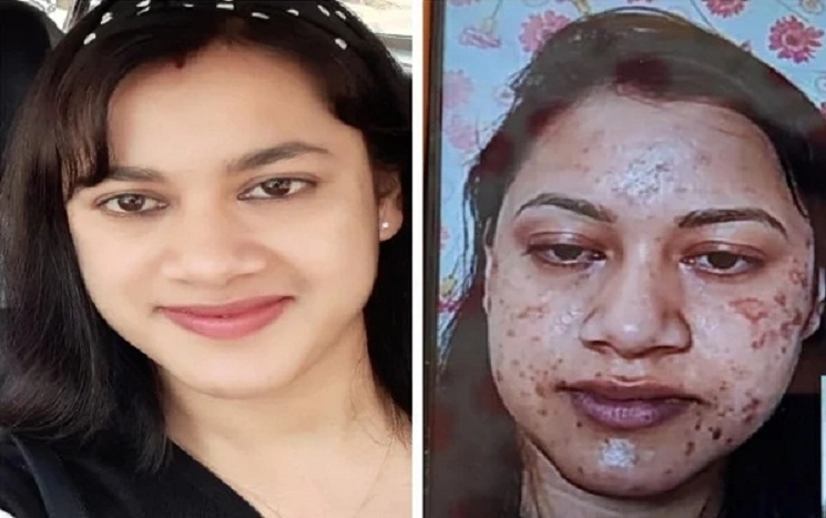 পার্লারে গিয়ে পুড়লো নারীর সুন্দর মুখ, নিজেই জানালেন ভয়াবহ সেই অভিজ্ঞতা