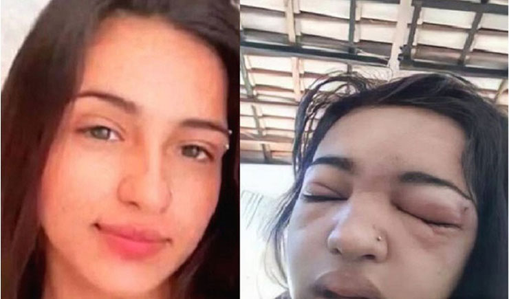 ফ্যাশন করতে গিয়ে, ইনফেকশনে অকালে মৃত্যু স্কুলছাত্রীর