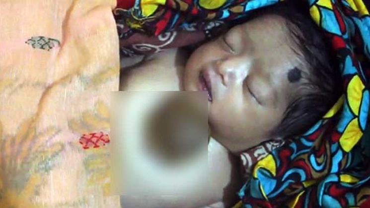 শরীরের বাইরে হৃৎপিণ্ড: বাঁচানো গেল না শিশুটিকে
