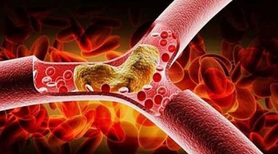 মাত্র ২ টাকায় দূর হবে কোলেস্টেরলের সমস্যা! মুক্তি পাবেন মারাত্মক রোগ থেকে