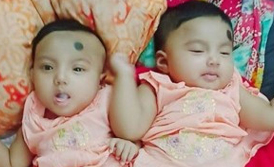 বিএসএমএমইউ- তে কুড়িগ্রামের জোড়া লাগানো ২ শিশুকে পৃথক করা হয়েছে