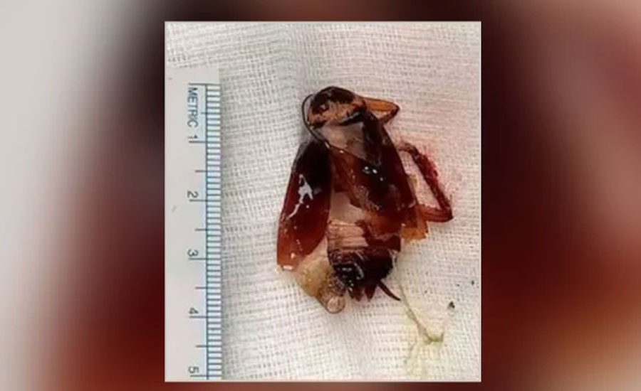 শ্বাসকষ্ট নিয়ে হাসপাতালে, ফুসফুসে মিলল তেলাপোকা!