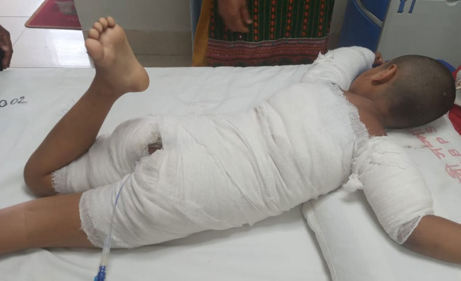 সোনারগাঁয়ে ৭ বছরের শিশুকে পুড়িয়ে হত্যার চেষ্টা