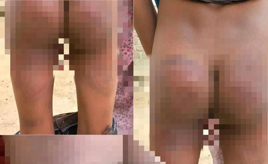 চুরির অভিযোগ দিয়ে মাদ্রাসা শিক্ষার্থীকে নির্যাতন