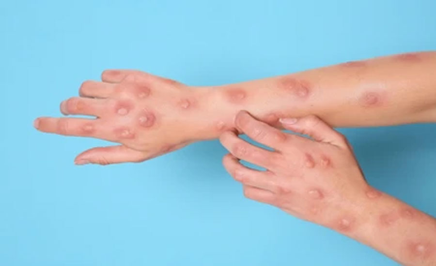 মাঙ্কিপক্স সংক্রমণের শঙ্কা, শাহজালাল বিমানবন্দরে সতর্কতা জারি