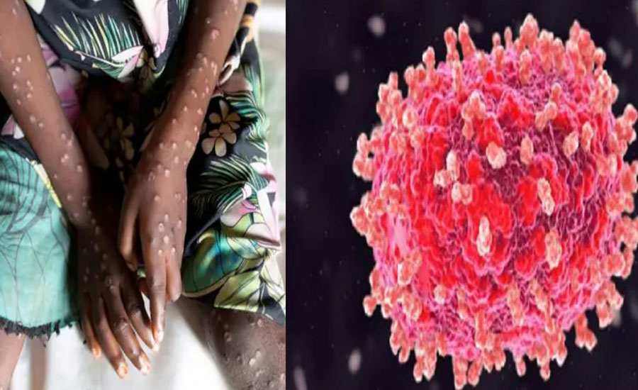 মাঙ্কিপক্স ও এমপক্স কি এক?