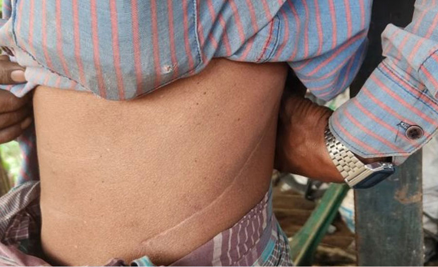 চাকরির আশায় ভারতে গিয়ে কিডনি খোয়ালেন ৩ বাংলাদেশি