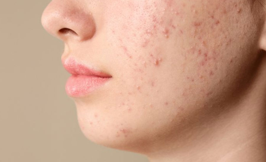 ব্রণ ও বলিরেখা চিরতরে দূর করবেন যেভাবে