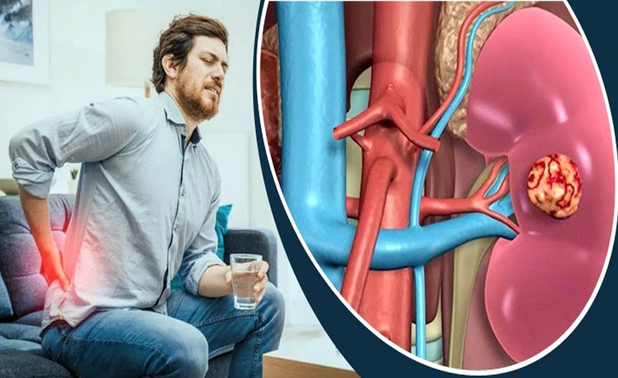 কিডনি ভালো রাখতে যে কাজগুলো করবেন