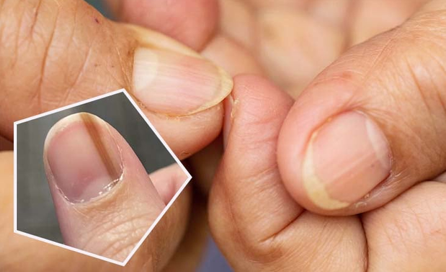 নখের ক্যানসার: নীরবে মরণব্যাধি রোগ হচ্ছে না তো, এই ৫ লক্ষণে সতর্ক হোন