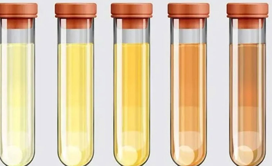 সকালের হলুদ প্রস্রাব, স্বাভাবিক না সমস্যার লক্ষণ?