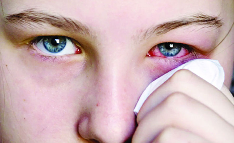 বর্ষায় চোখের সংক্রমণ এড়াতে কী করবেন