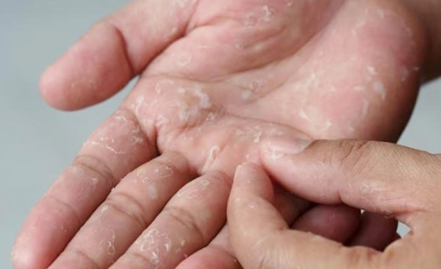 যে ভিটামিনের অভাবে হাত-পায়ের চামড়া ওঠে