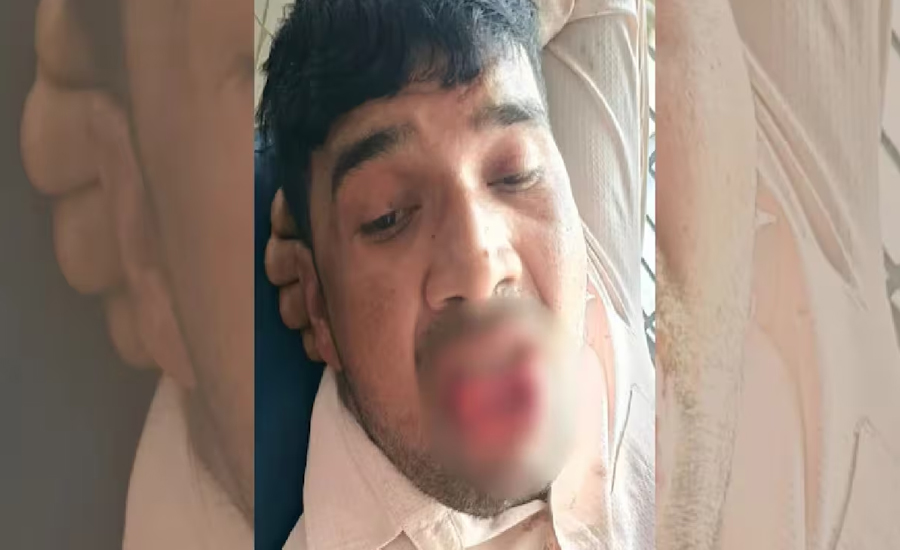 সাবেক প্রেমিকাকে চুমু, কামড়ে ছিন্ন প্রেমিকের জিহ্বা