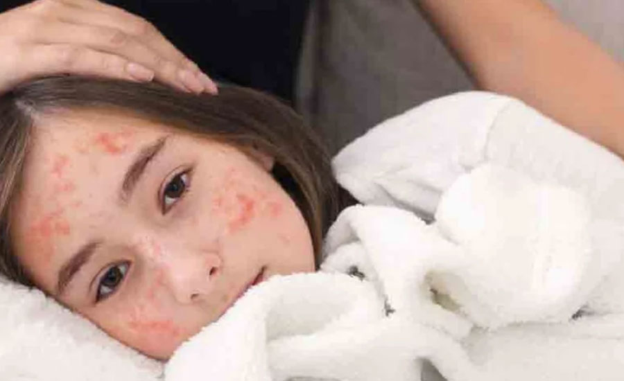 হাম হলে কী করবেন