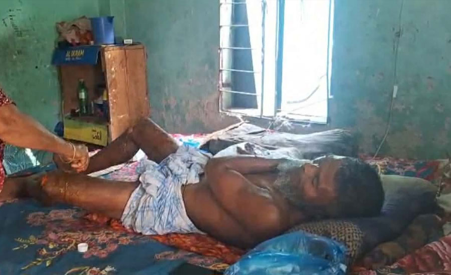 পারিবারিক কলহে আগুনের চেষ্টা: ছেলেকে বাঁচাতে গিয়ে দগ্ধ বাবা