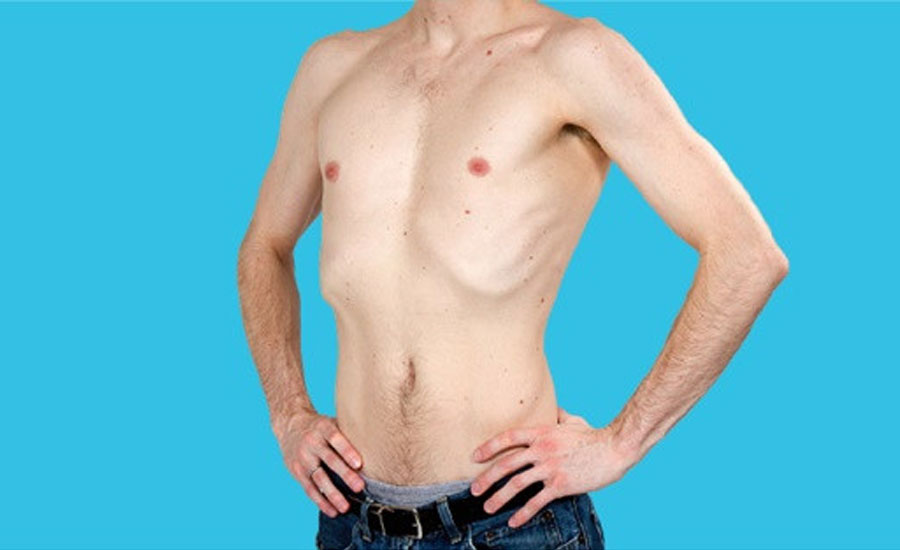 অস্বাভাবিক ওজন কমে যাওয়া হতে পারে যেসব রোগের লক্ষণ